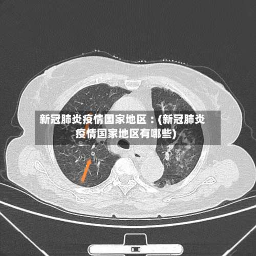 新冠肺炎疫情国家地区︰(新冠肺炎疫情国家地区有哪些)-第1张图片